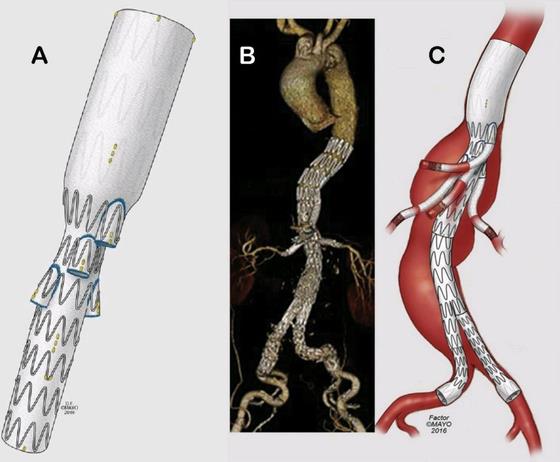 India''s Quiet Vascular Crisis: Thousands Die Each Year From an Aneurysm They Never Knew They Had